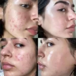 ژل ضد جوش دیفرین - Image 2